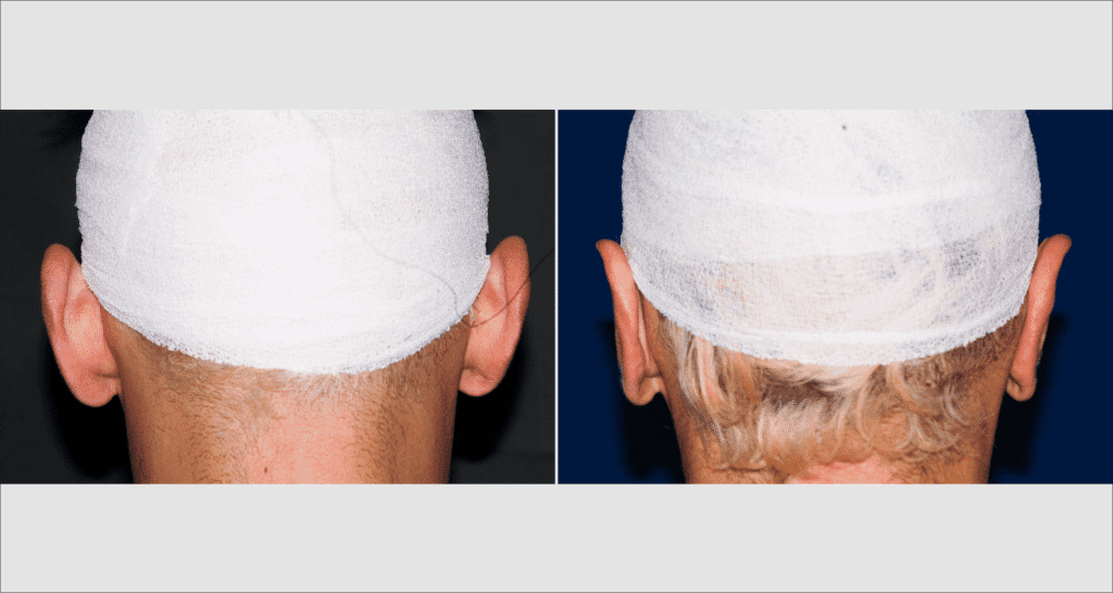 Vorher/Nachher Ergebnis: Abstehende Ohren