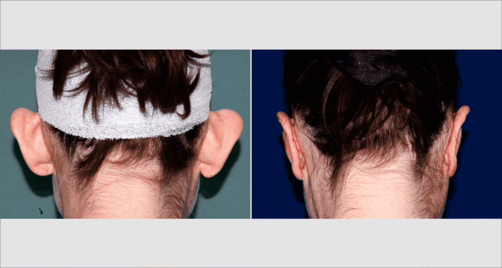 Vorher/Nachher Ergebnis: Abstehende Ohren