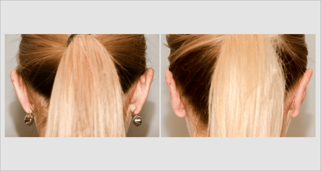 Vorher/Nachher Ergebnis: Abstehende Ohren