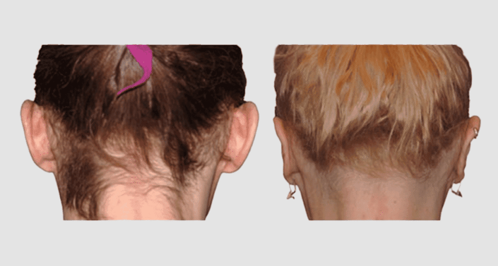 Vorher/Nachher Ergebnis: Abstehende Ohren