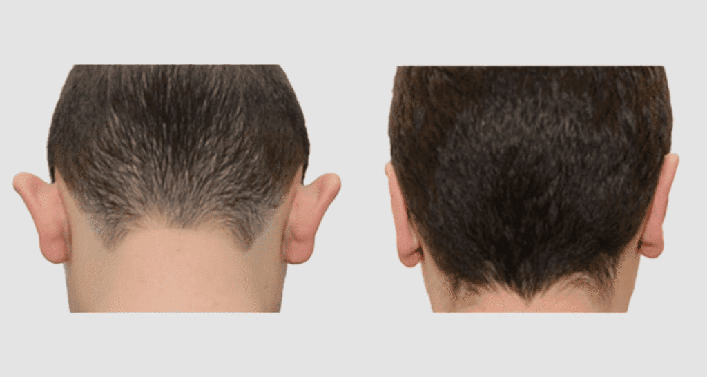 Vorher/Nachher Ergebnis: Abstehende Ohren