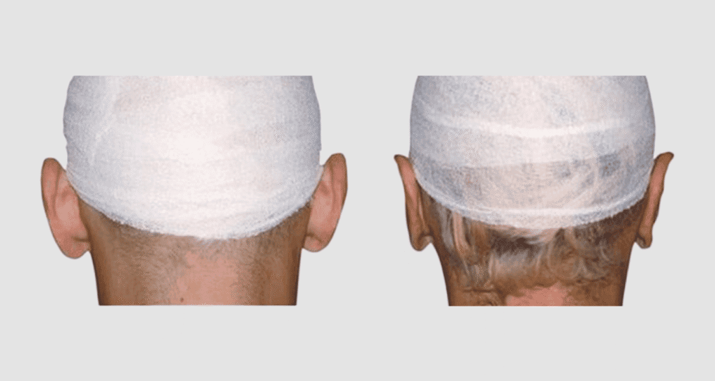 Vorher/Nachher Ergebnis: Abstehende Ohren