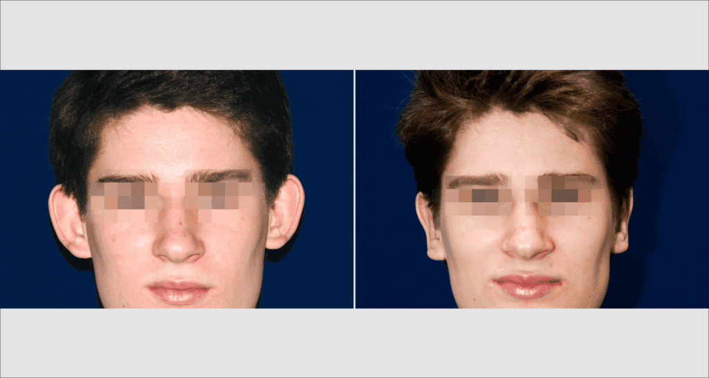 Vorher/Nachher Ergebnis: Abstehende Ohren