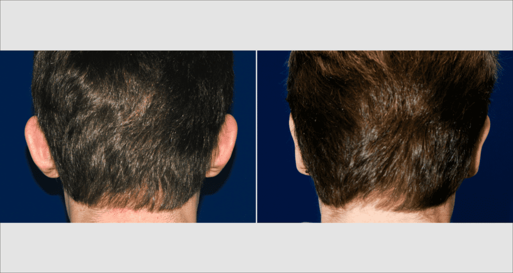 Vorher/Nachher Ergebnis: Abstehende Ohren