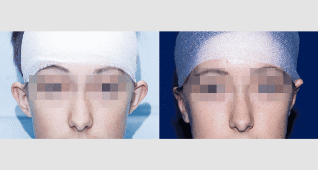 Vorher/Nachher Ergebnis: Abstehende Ohren