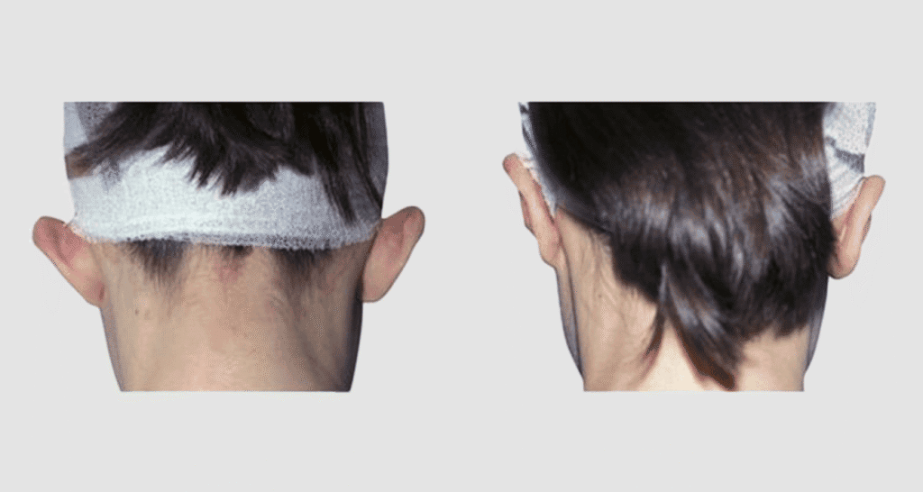 Vorher/Nachher Ergebnis: Abstehende Ohren