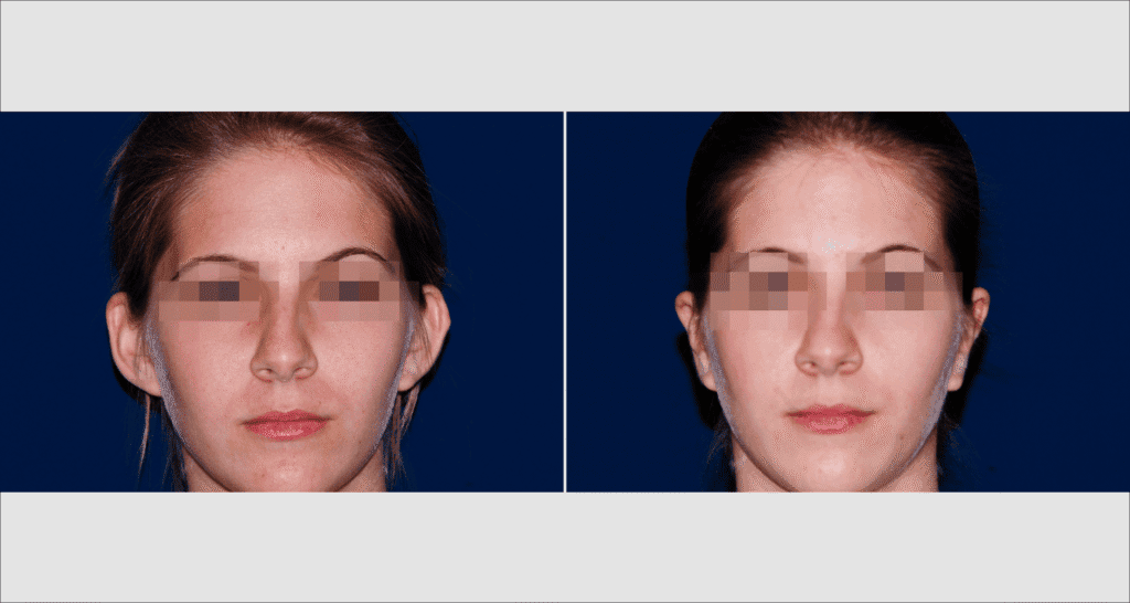 Vorher/Nachher Ergebnis: Abstehende Ohren