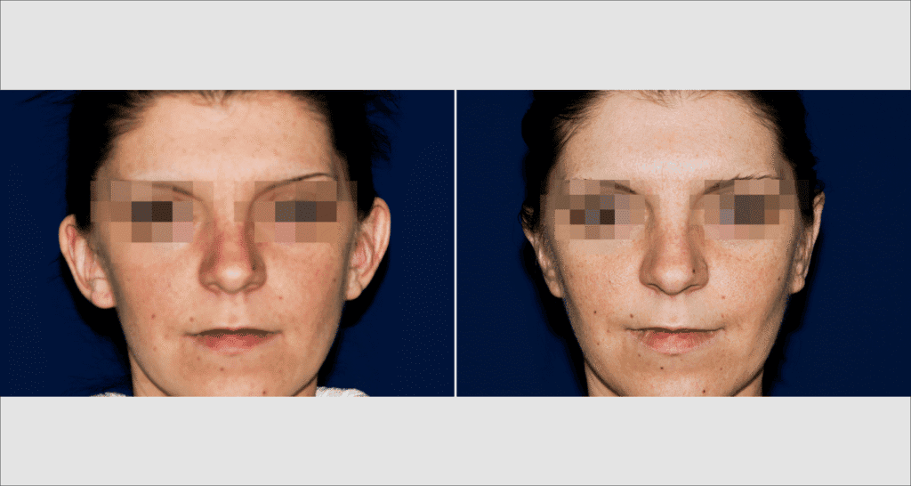 Vorher/Nachher Ergebnis: Abstehende Ohren