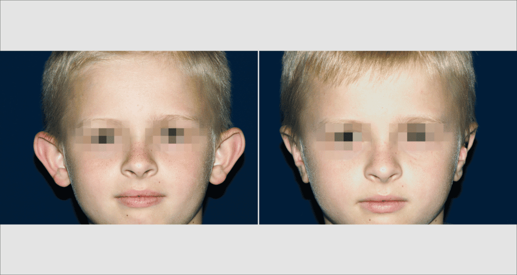 Vorher/Nachher Ergebnis: Abstehende Ohren