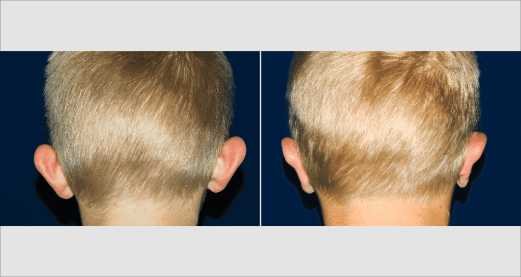 Vorher/Nachher Ergebnis: Abstehende Ohren