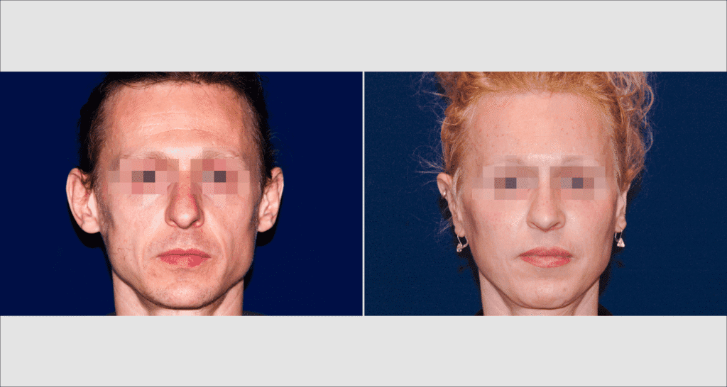 Vorher/Nachher Ergebnis: Abstehende Ohren