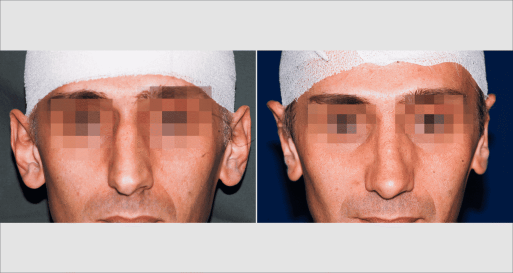 Vorher/Nachher Ergebnis: Abstehende Ohren