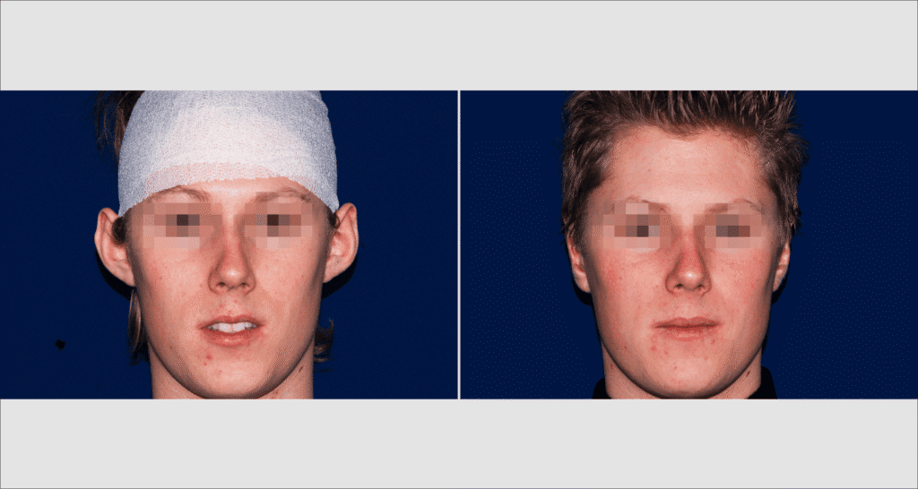 Vorher/Nachher Ergebnis: Abstehende Ohren