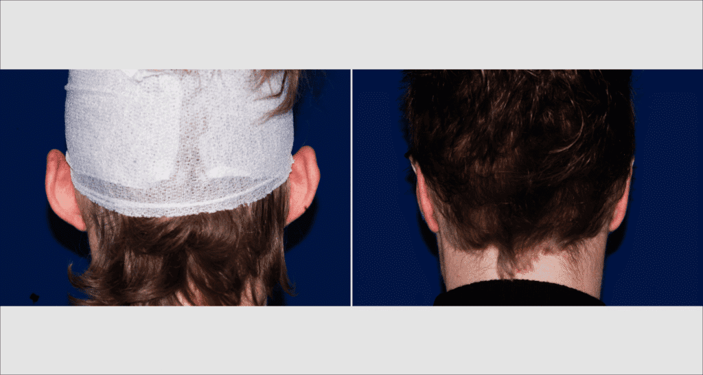 Vorher/Nachher Ergebnis: Abstehende Ohren