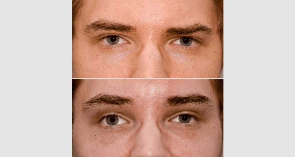 Nahaufnahme von Haut mit Akne vor und nach Behandlung, Hautverbesserung sichtbar.