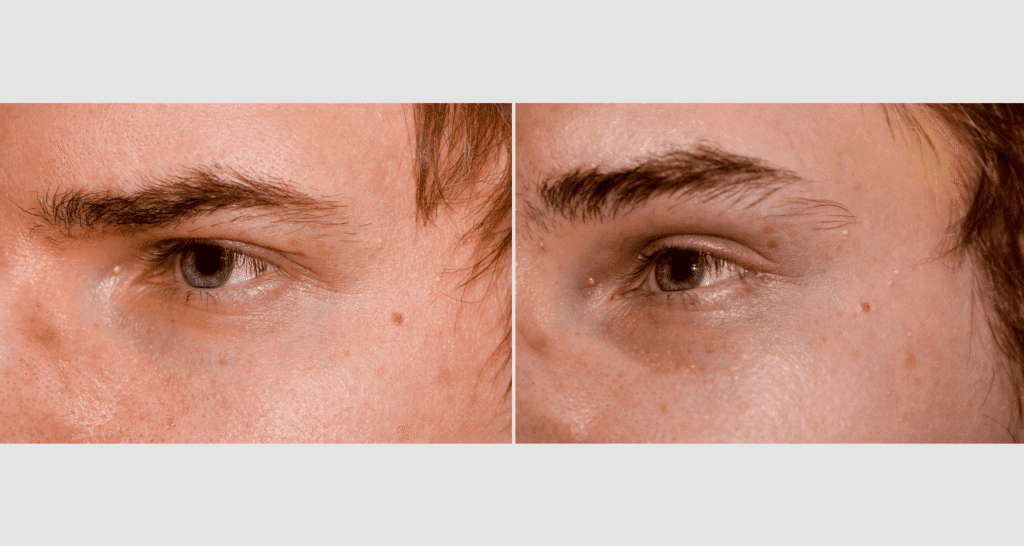 Vergleich der Haut um die Augen mit und ohne Hautpflege.