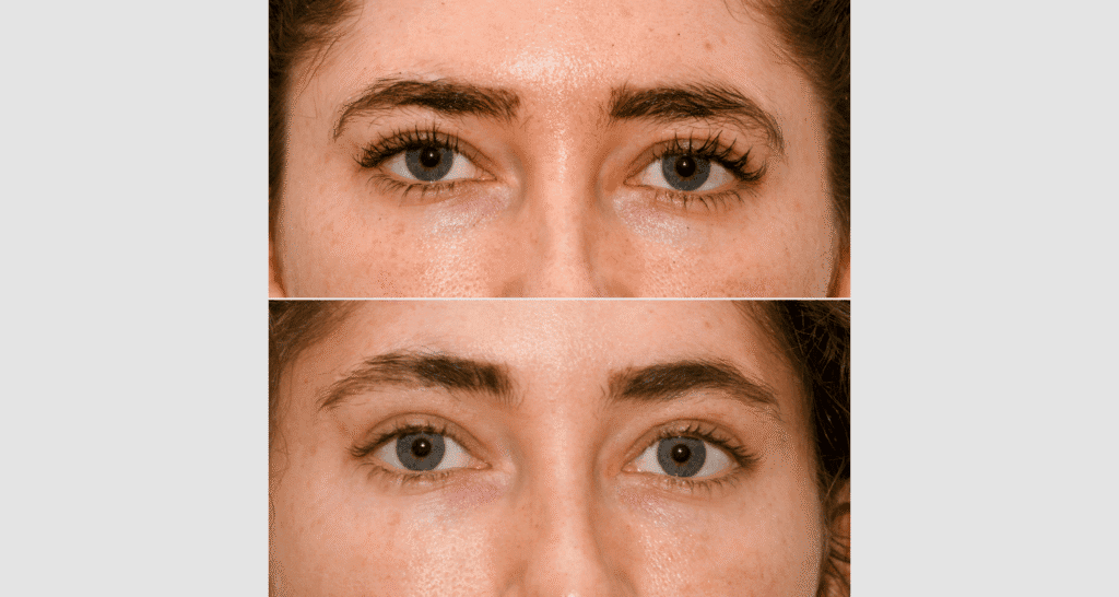 Nahaufnahme von Haut vor und nach einer Hautbehandlung, Fokus auf Gesicht.