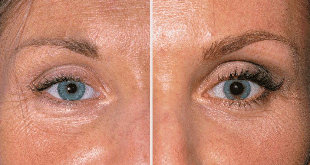 Vorher-Nachher Vergleich der Haut um die Augen, Hautstraffung sichtbar.