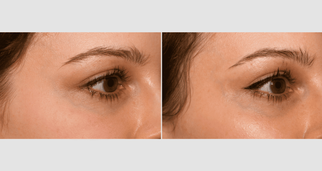 Vergleich der Haut vor und nach einer Hautpflegebehandlung, sichtbare Verbesserung der Hautstruktur.