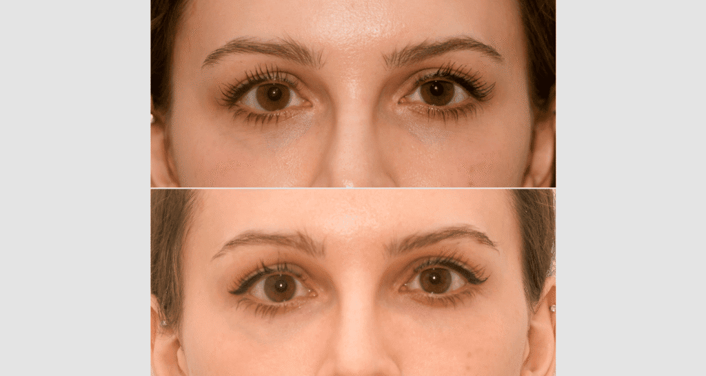 Nahaufnahme eines Gesichts vor und nach Hautbehandlung, Fokus auf Augen und Hauttextur.