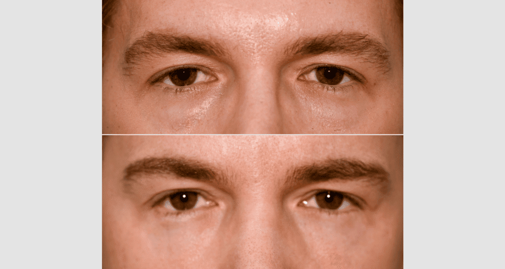 Nahaufnahme eines Mannes mit Hautveränderungen vor und nach Hautbehandlung.