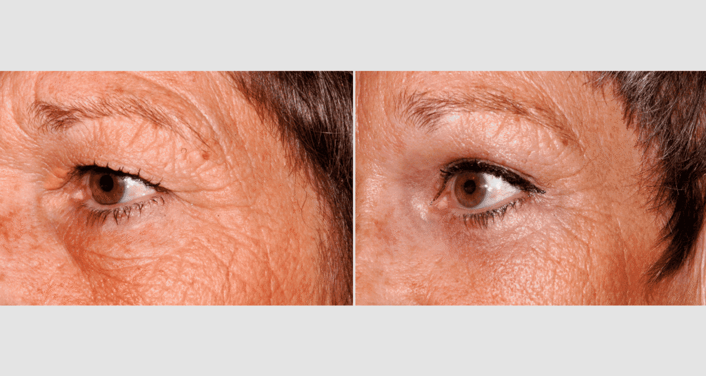 Nahaufnahme von Haut mit Falten vor und nach Hautpflegebehandlung.