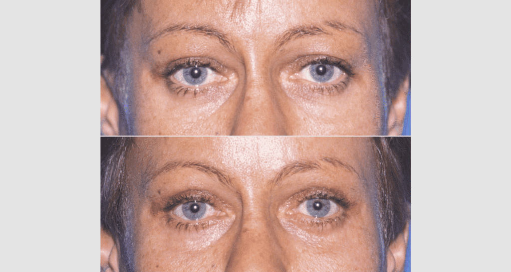 Nahaufnahme von Gesicht mit Hautalterungsanzeichen, Hautpflege im Fokus.