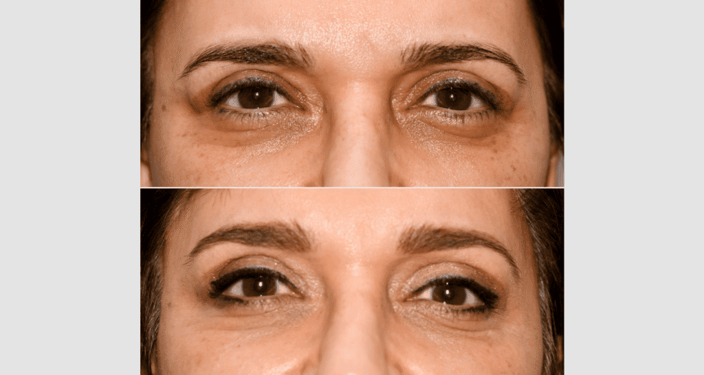 Nahaufnahme von Haut vor und nach einer kosmetischen Behandlung.