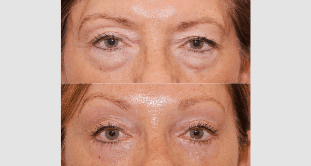 Vorher-Nachher Vergleich von Hautstraffung bei Augenpartie.