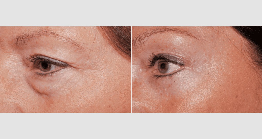 Vorher-Nachher Vergleich der Hautpflege gegen Augenfalten.