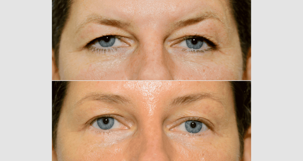 Vorher-nachher Vergleich der Hautpflege bei Augenpartie und Stirn.