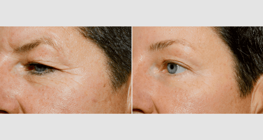 Vorher-Nachher Vergleich der Hautstraffung im Augenbereich.