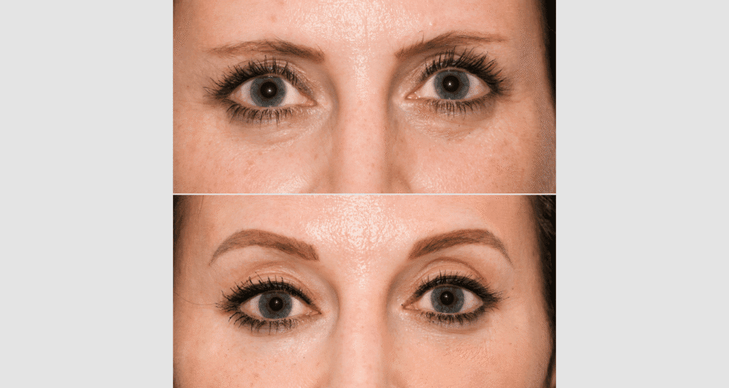 Nahaufnahme von Haut vor und nach einer kosmetischen Behandlung.