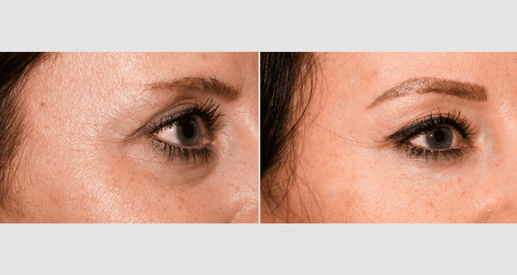 Vorher-Nachher Vergleich der Hautstraffung im Augenbereich.