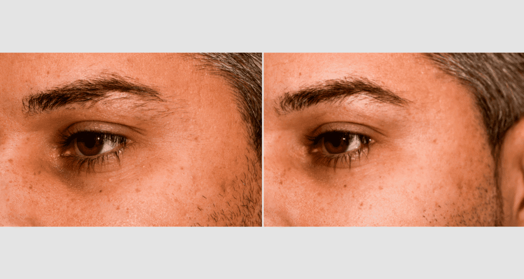 Nahaufnahme eines Gesichts mit Akne und Pigmentflecken, Hautpflege-Tipps.