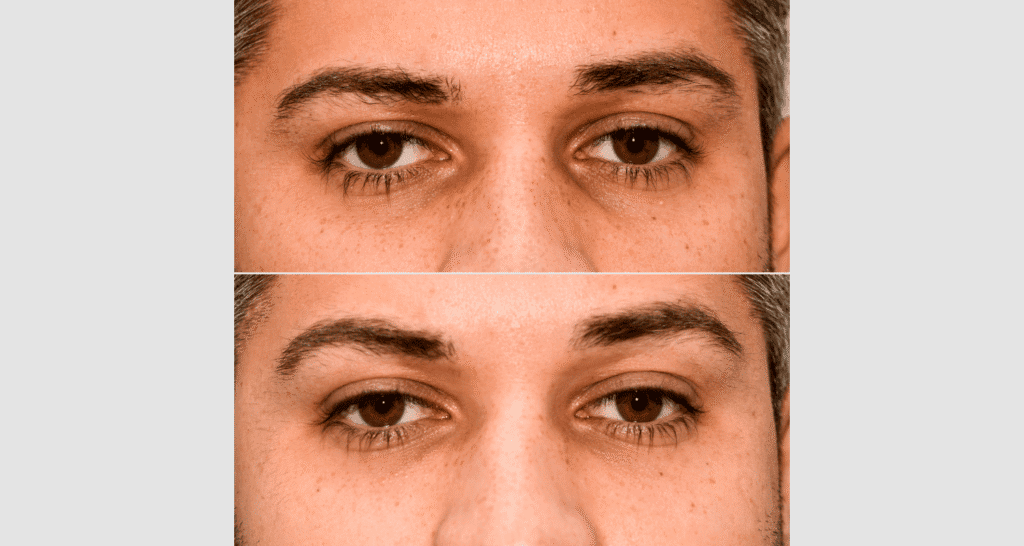 Nahaufnahme eines Mannes mit Hautunreinheiten und Rötungen im Gesicht.