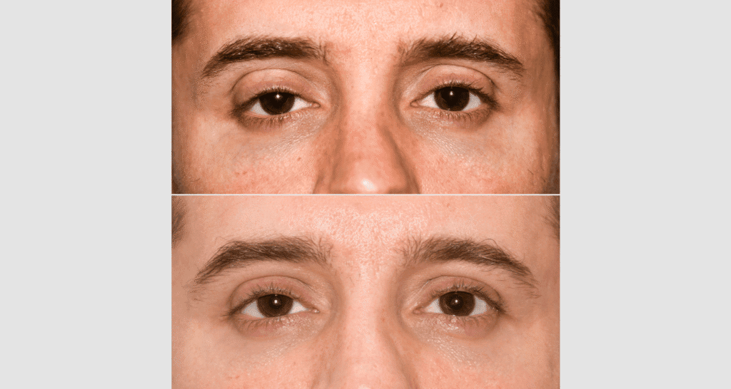 Nahaufnahme eines Gesichts mit Hautunreinheiten und reiner Haut.