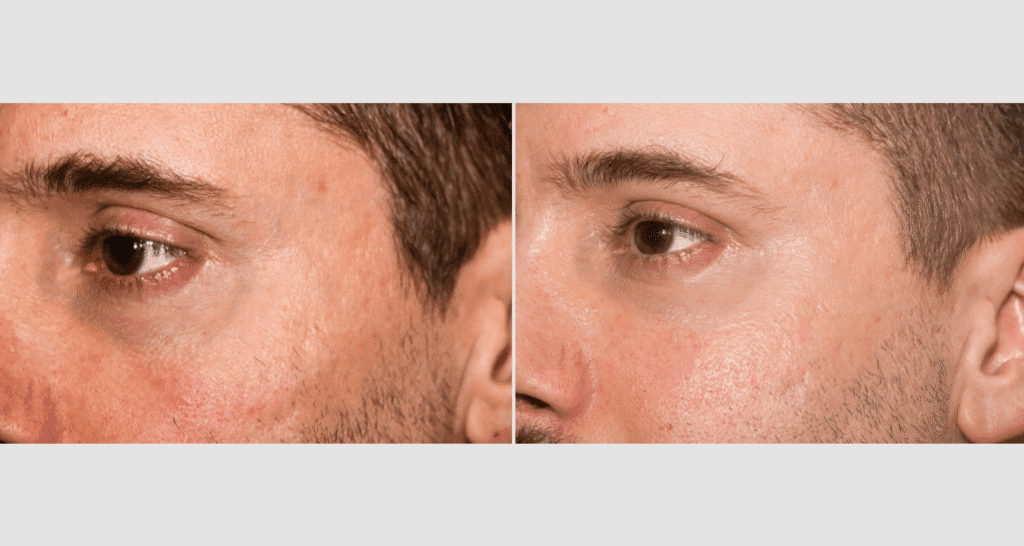 Vorher-Nachher Vergleich der Hautverjüngung bei einem Mann.