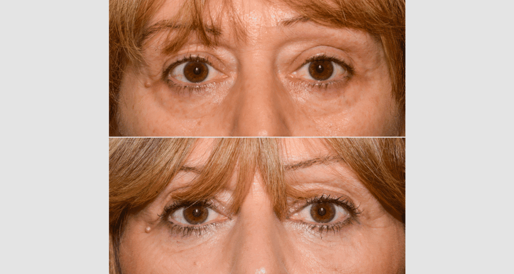 Frau mit Augenringen vor und nach Hautbehandlung, sichtbare Verbesserung.