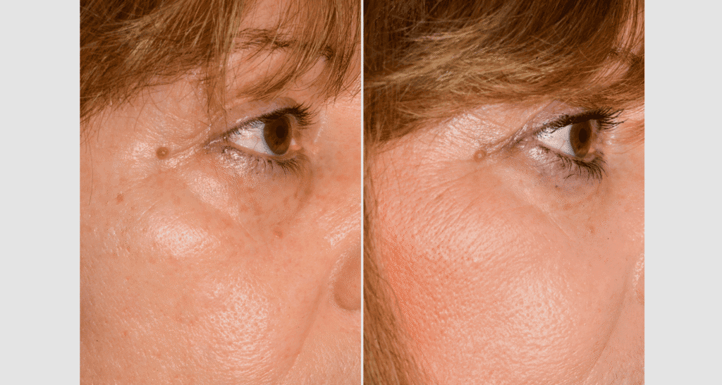 Vorher-Nachher Vergleich der Hautstraffung bei Hautverjüngung.