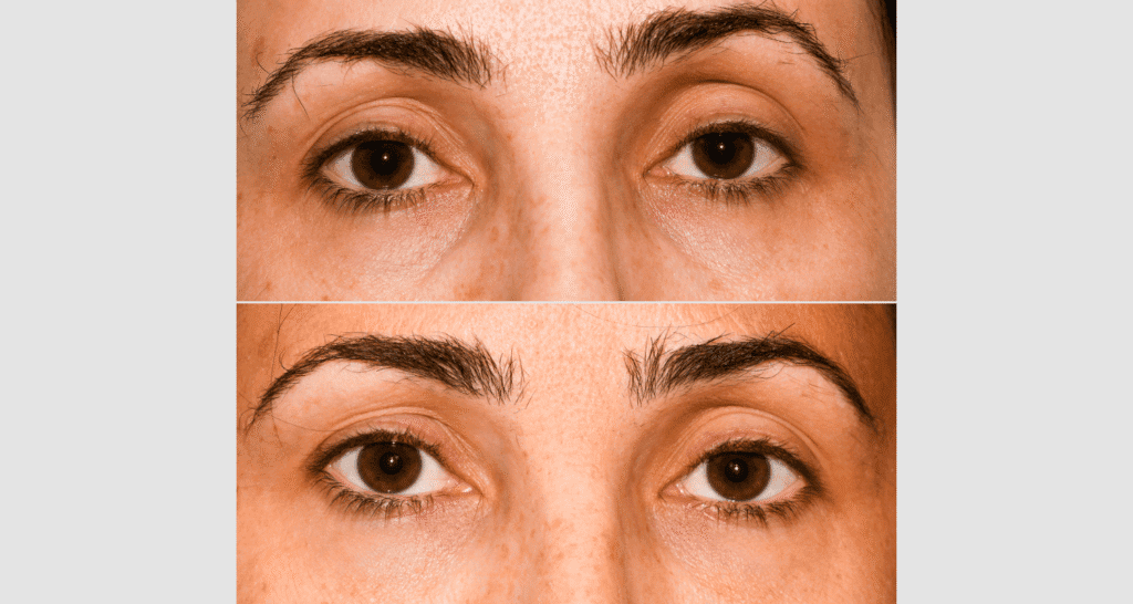 Nahaufnahme von Augen mit und ohne Augenringe, Hautpflege im Fokus.