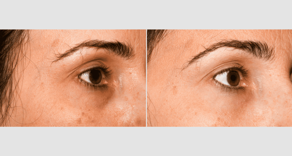 Nahaufnahme eines Gesichts vor und nach Hautbehandlung, Hautbild verbessert.