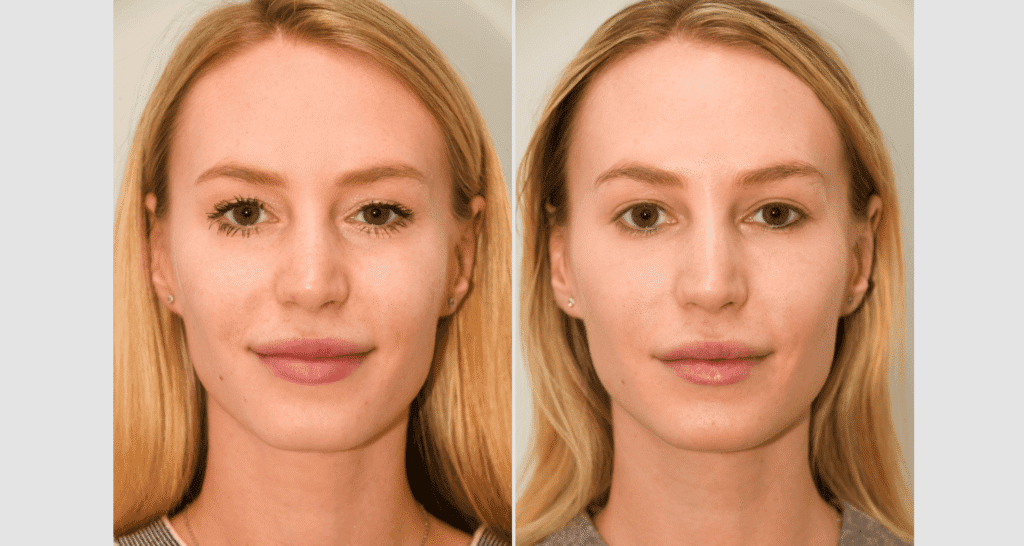 Frau vor und nach Hautbehandlung, Hautbildverbesserung sichtbar.