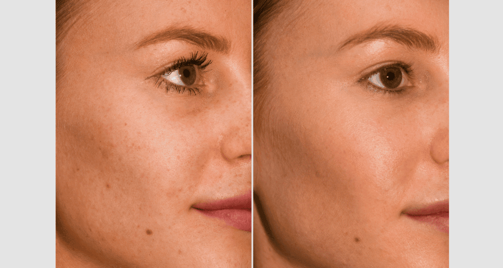 Vorher-Nachher Vergleich einer Hautverjüngungskur bei einer Frau.