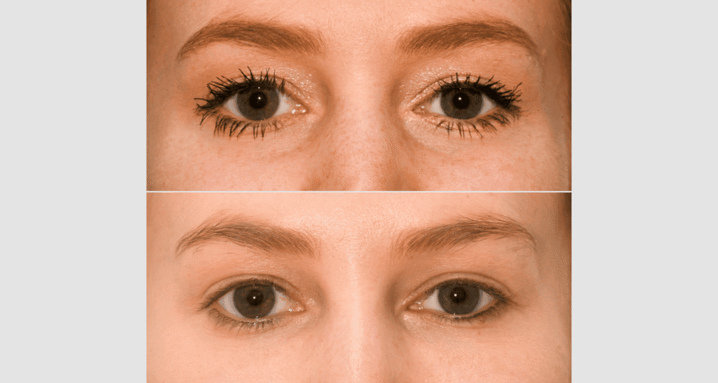 Vergleich der Haut vor und nach einer Hautbehandlung, Hautverbesserung sichtbar.