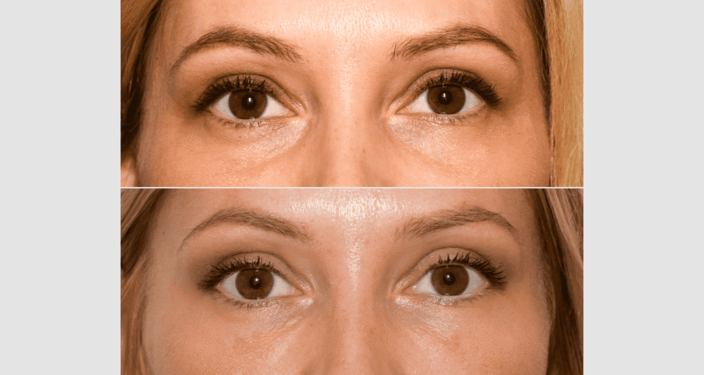 Nahaufnahme der Augenpartie, zeigt Hautveränderungen vor und nach einer kosmetischen Behandlung.