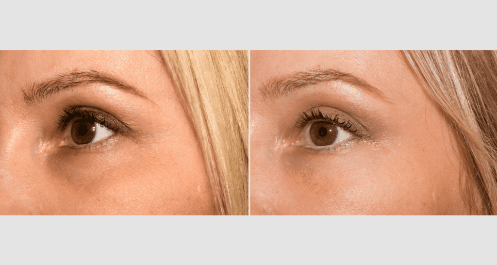 Nahaufnahme eines Gesichts vor und nach Hautbehandlung, Hautverbesserung sichtbar.