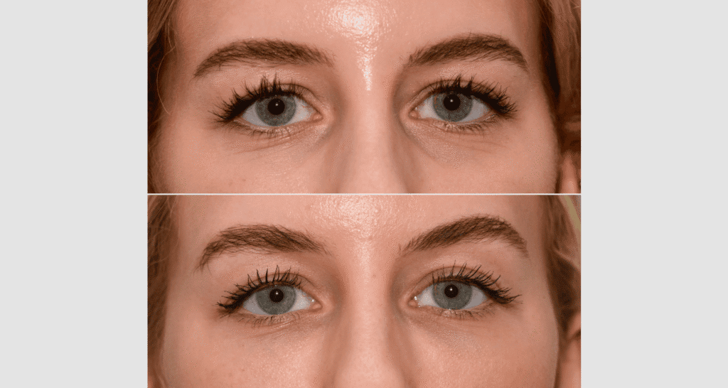 Nahaufnahme eines Gesichts vor und nach Hautbehandlung, Fokus auf Hautverbesserung.