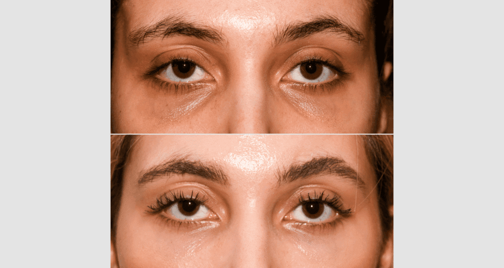 Nahaufnahme von Gesicht mit Hautunreinheiten und Hautverbesserung.