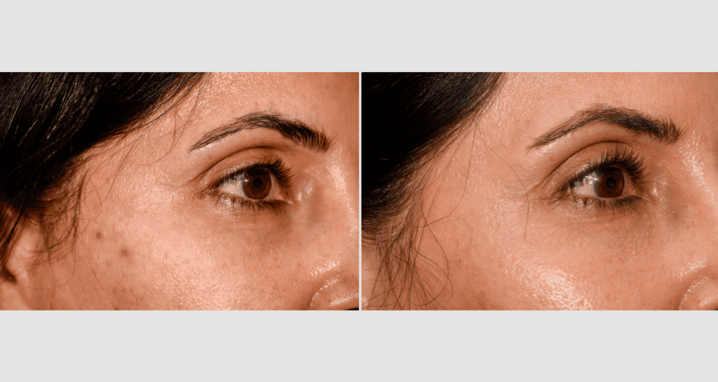 Vergleich der Haut vor und nach einer Hautbehandlung, Hautverbesserung sichtbar.